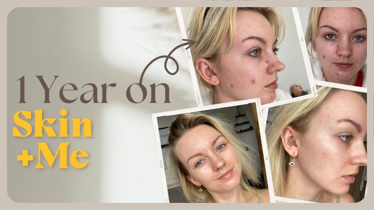 Skin + Me, обзор за 1 год | Очищение от пигментации