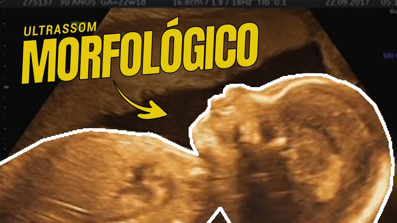 Ultrassom Morfológico COMPLETO | 22 semanas