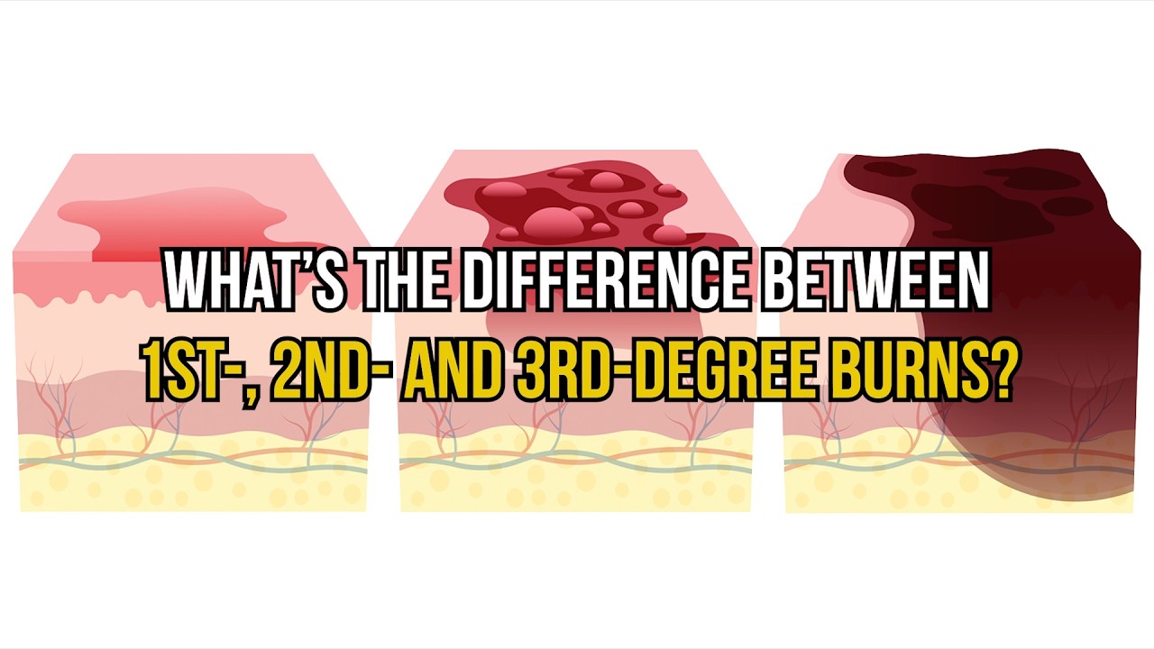 What's the difference between 1st-, 2nd- and 3rd-degree burns?