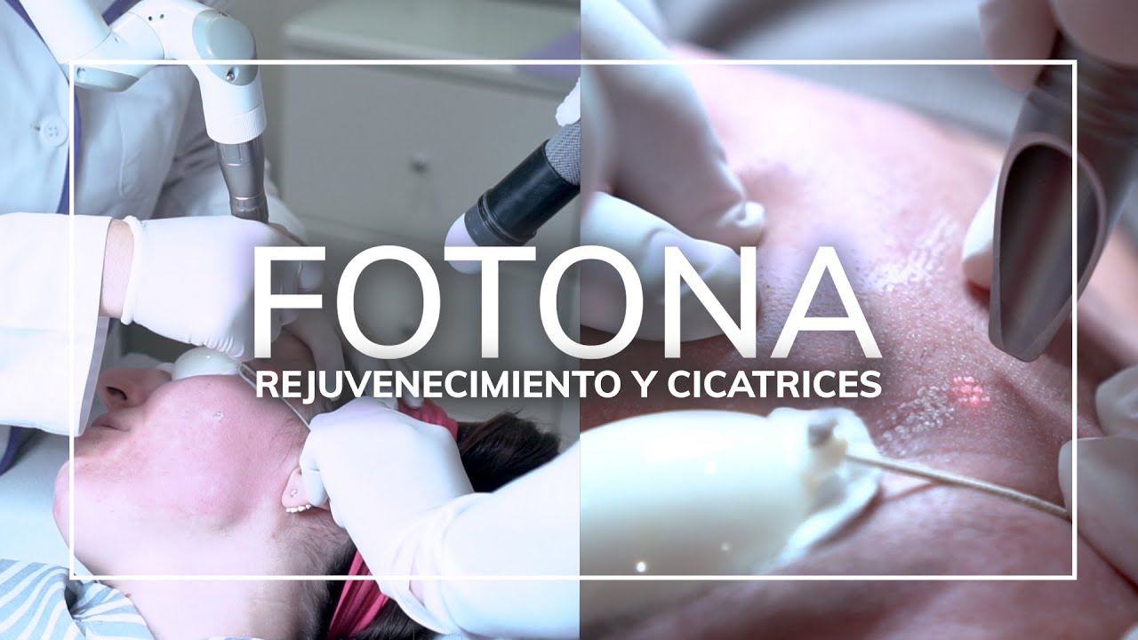 Elimina las cicatrices y consigue una piel más rejuvenecida con el Láser Fotona