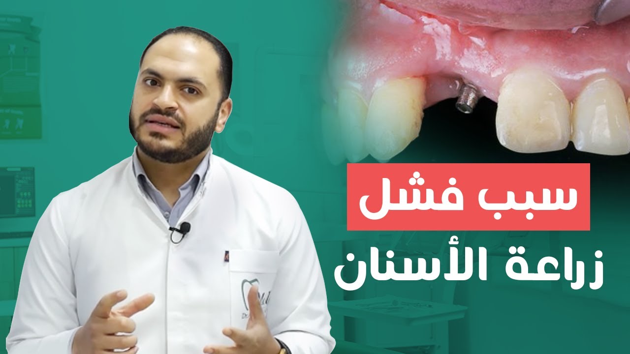 أسباب فشل زراعة الأسنان و علاقتها بهشاشة العظام و التدخين
