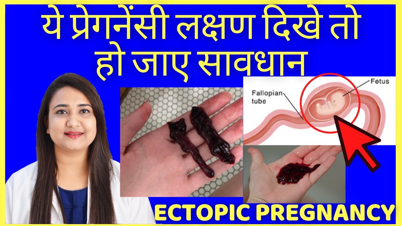 ये प्रेगनेंसी लक्षण दिखे तो हो जाए सावधान | ECTOPIC PREGNANCY CAUSES, SYMPTOMS & TREATMENT