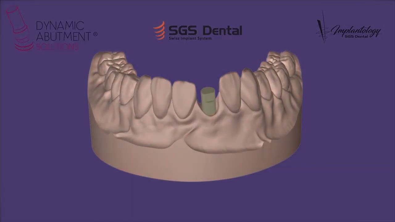 Dynamic Abutment Solutions