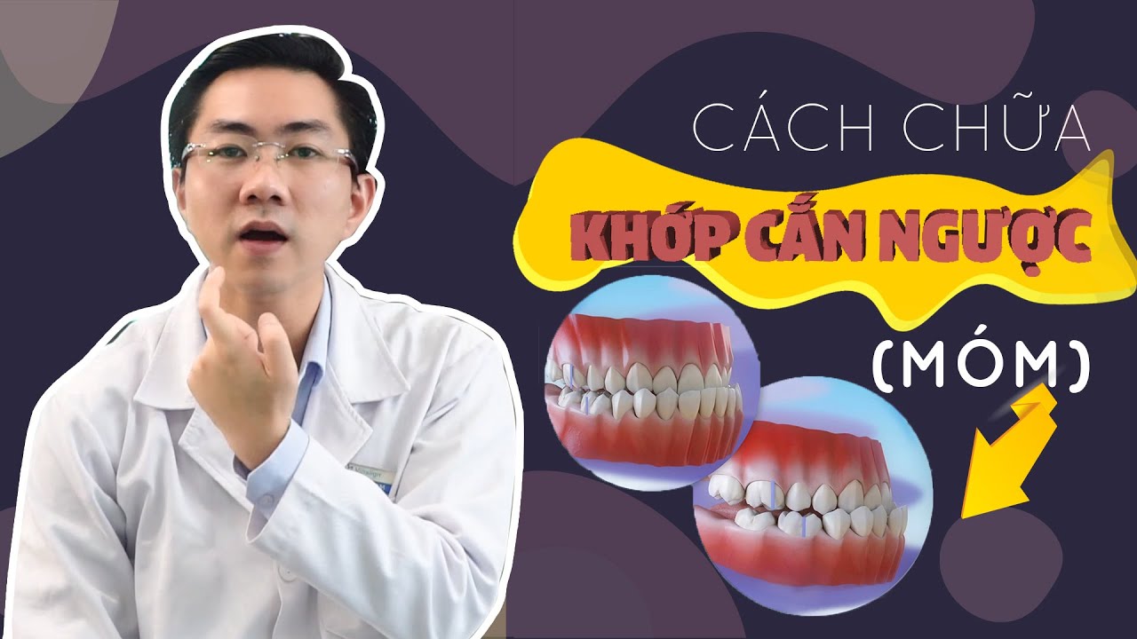 Khớp Cắn Ngược Và Những Cách Điều Trị Hiệu Quả Tại Vinalign