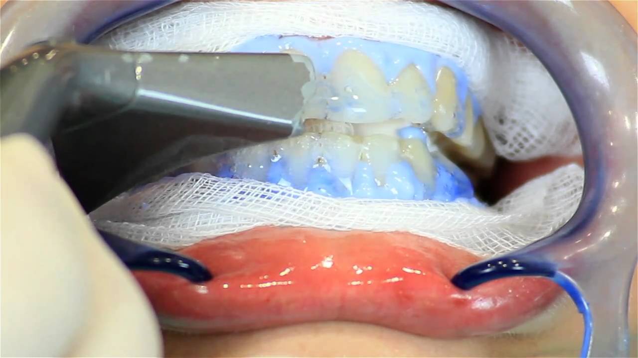 Branqueamento Dentário - Técnica Laser