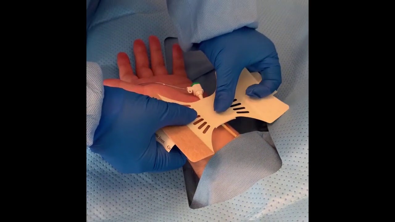QuikClot Radial In Service
