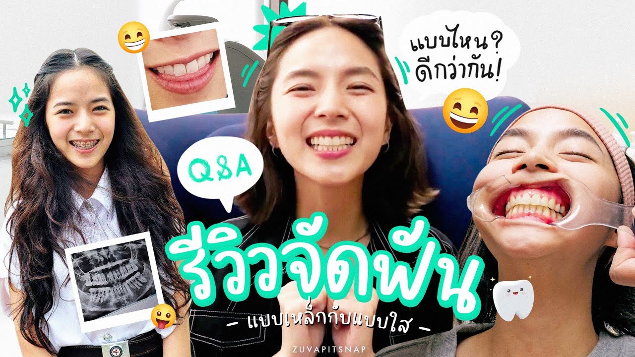 Вопросы и ответы: Обзор брекетов: что лучше: металлические или прозрачные? | ZuvapitSnap