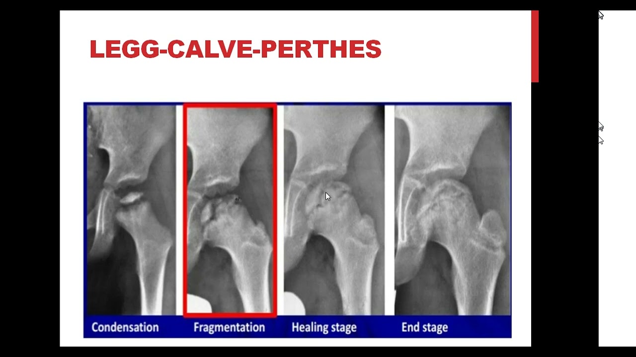 Osteonecrosis Prof Hesham ElSheikh MD