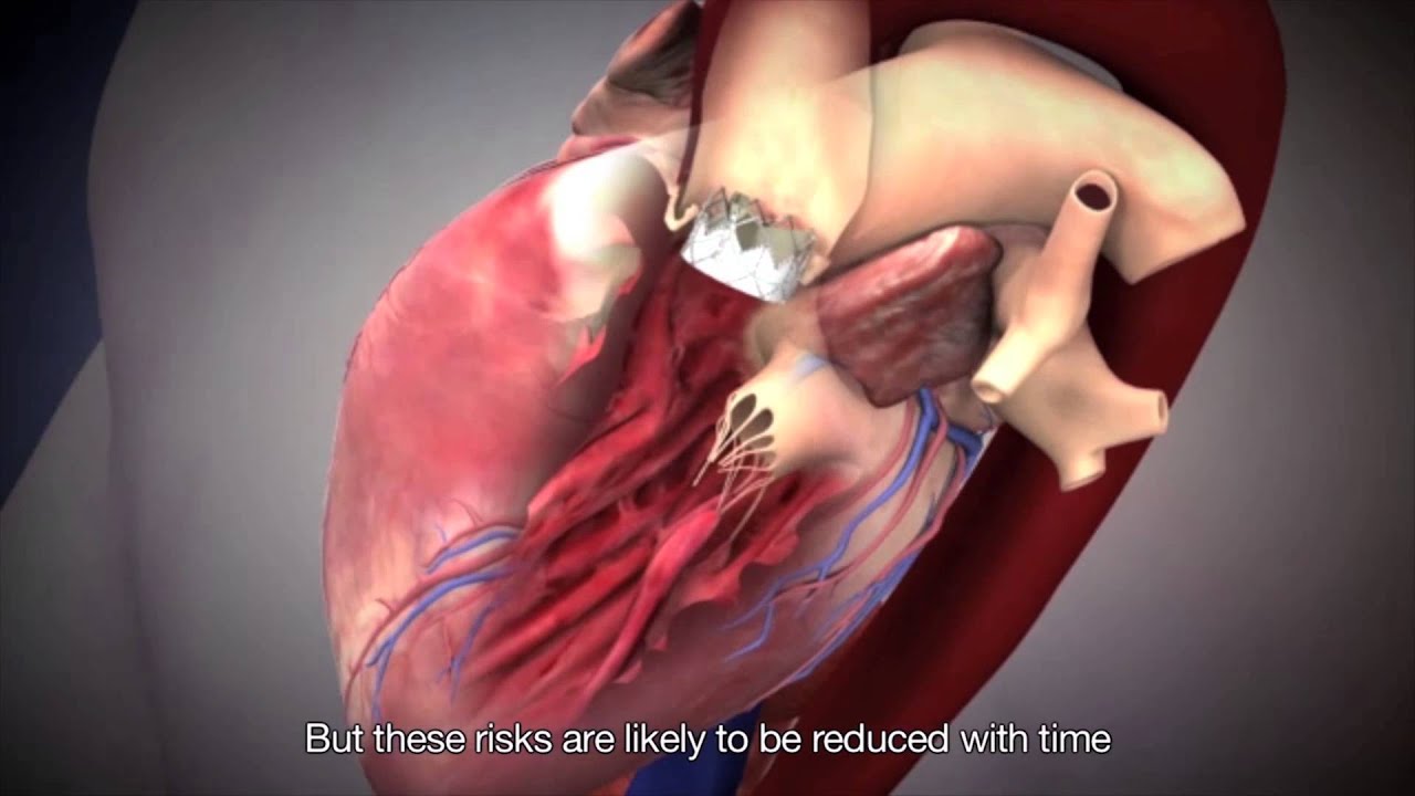 NUHCS - Transcatheter Aortic Valve Implantation (TAVI) (with English Subtitles)