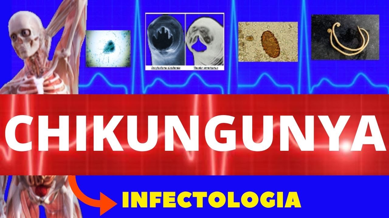 CHIKUNGUNYA - CAUSAS, SINTOMAS, DIAGNÓSTICO E TRATAMENTO - INFECTOLOGIA