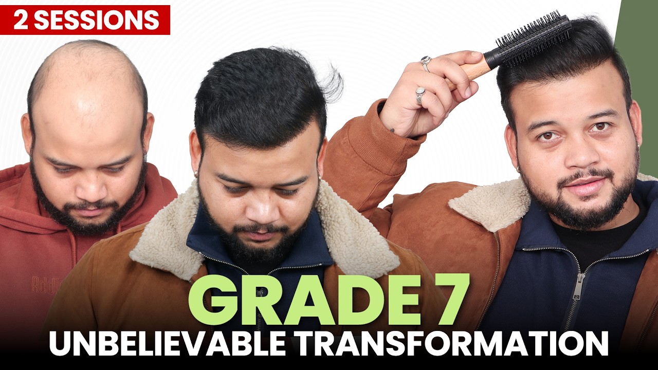 Hair Transplant in Ranchi (HX-HHGY) | Best Results & Cost of Hair Transplant in Ranchi