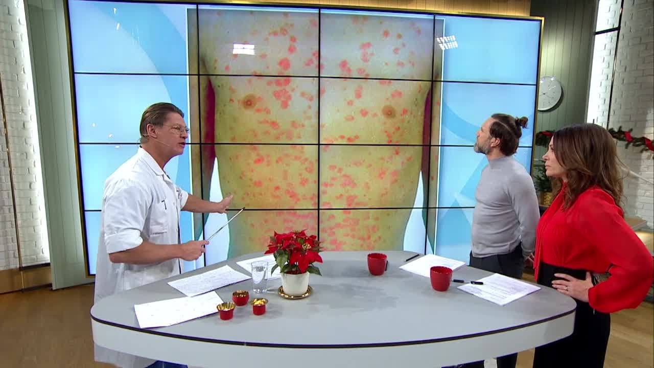 Dr Mikael om Psoriasis: 