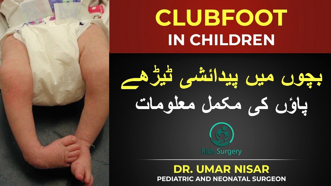 Complete information on Congenital Clubfoot in children | Congenital Telepes Equinovarus |Umar Nisar