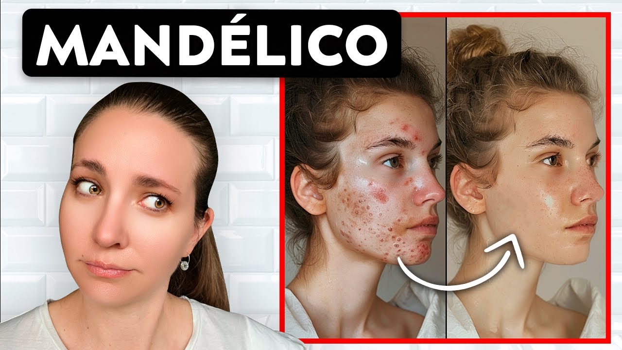 ÁCIDO MANDÉLICO: la alternativa al SALICÍLICO para ELIMINAR el acné (es mejor)