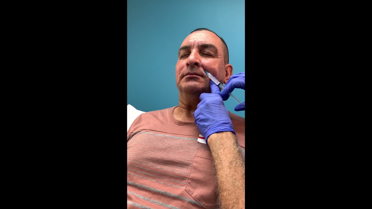 Treating HIV Patients with Facial Fillers