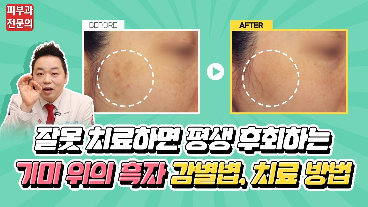 흑자 한번에 치료해드립니다? 속지 마세요.  : 잘못 치료하면 평생 후회하는 기미 위의 흑자 - 감별법, 치료방법