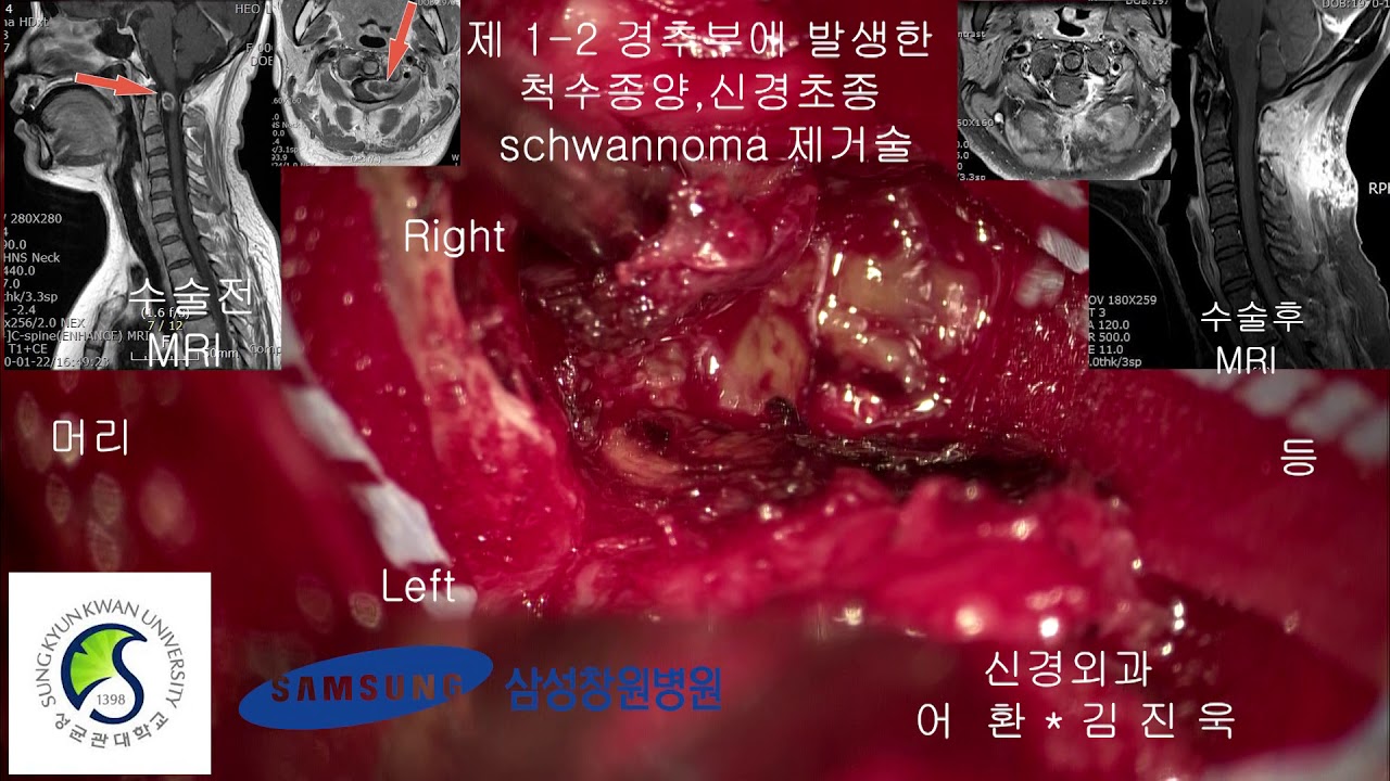제1-2경추부에 발생한 척수종양 신경초종 schwannoma 제거술