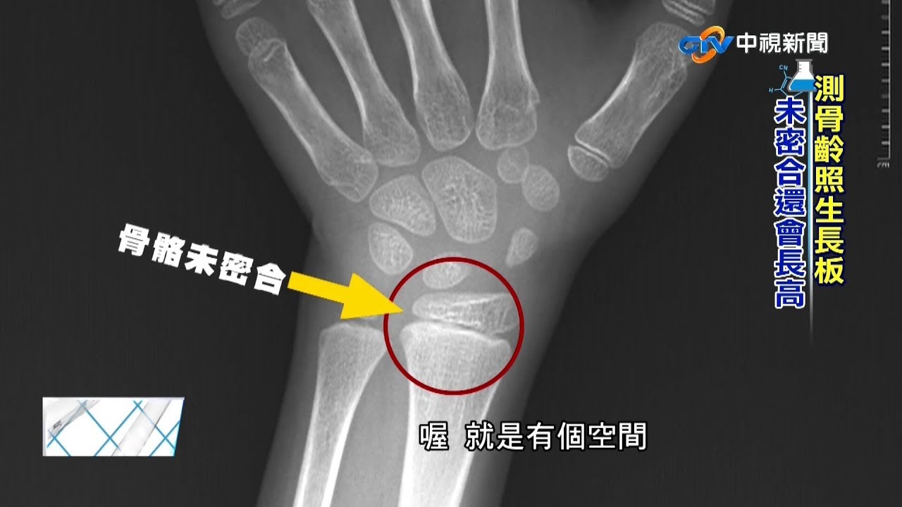 人體實驗室_小孩是否還會長高-測骨齡照生長板_亞東高銓宏+黃晴