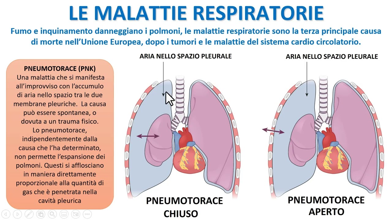 LE PATOLOGIE DEL SISTEMA RESPIRATORIO