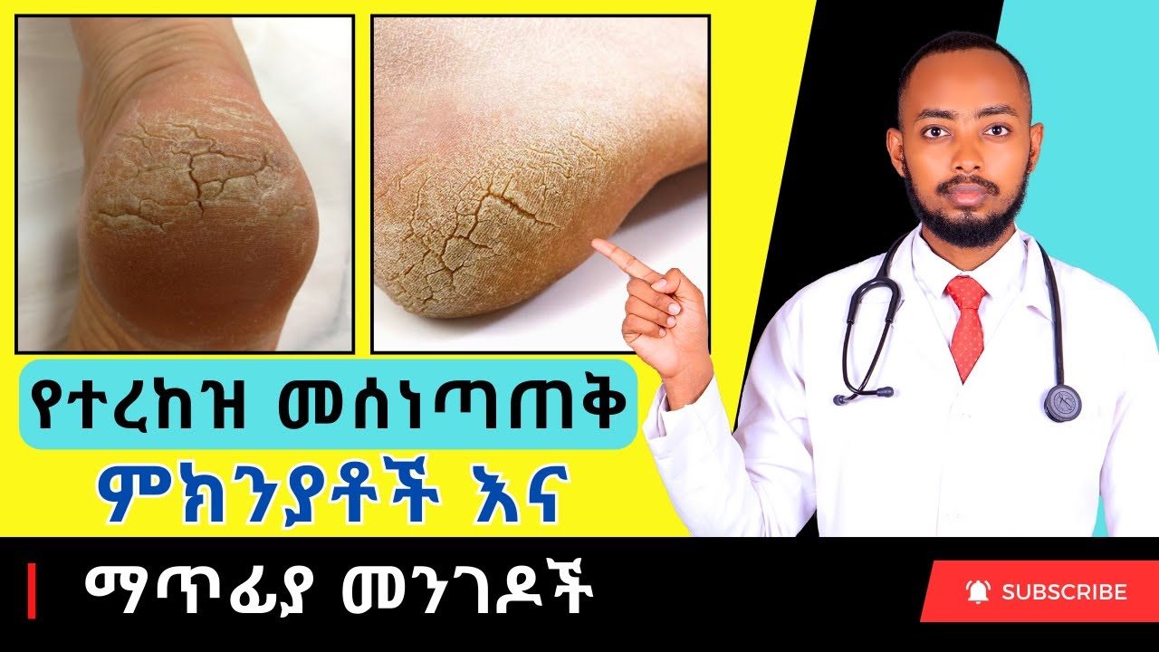 Ethiopia | የተረከዝ መሰነጣጠቅ ምክንያቶች እና ማጥፊያ መንገዶች - Cracked heel causes and solutions