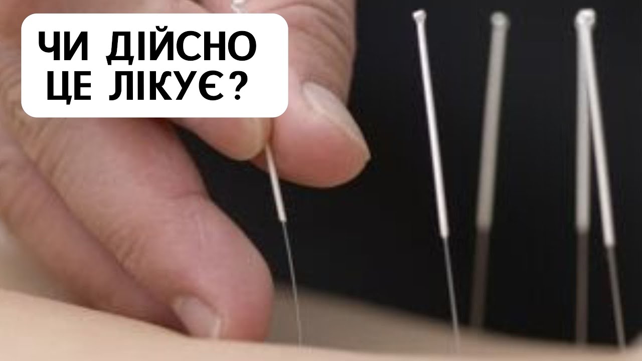 ЧИ ДІЙСНО ЦЕ ЛІКУЄ? Голковколювання.