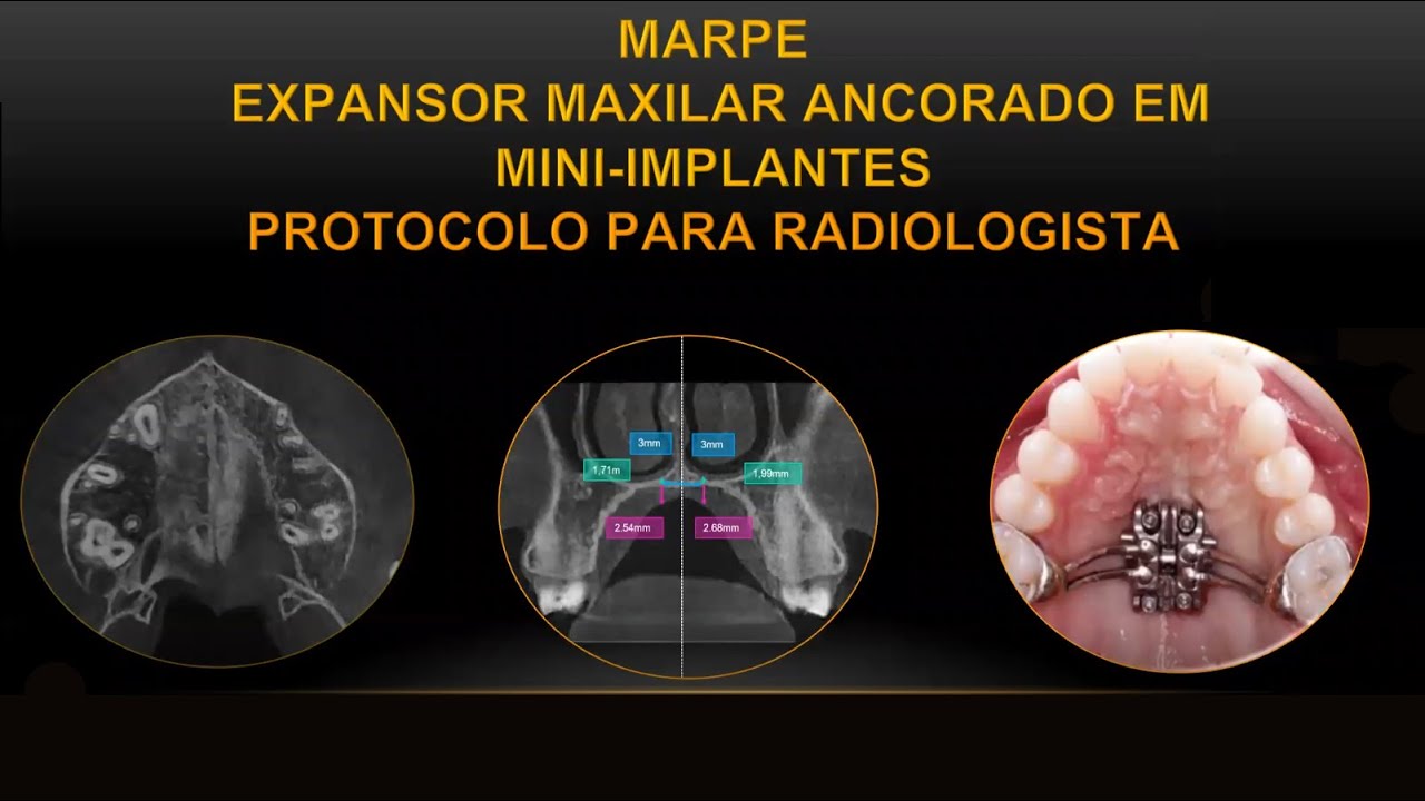 LIVE Vatech - MARPE para Radiologistas