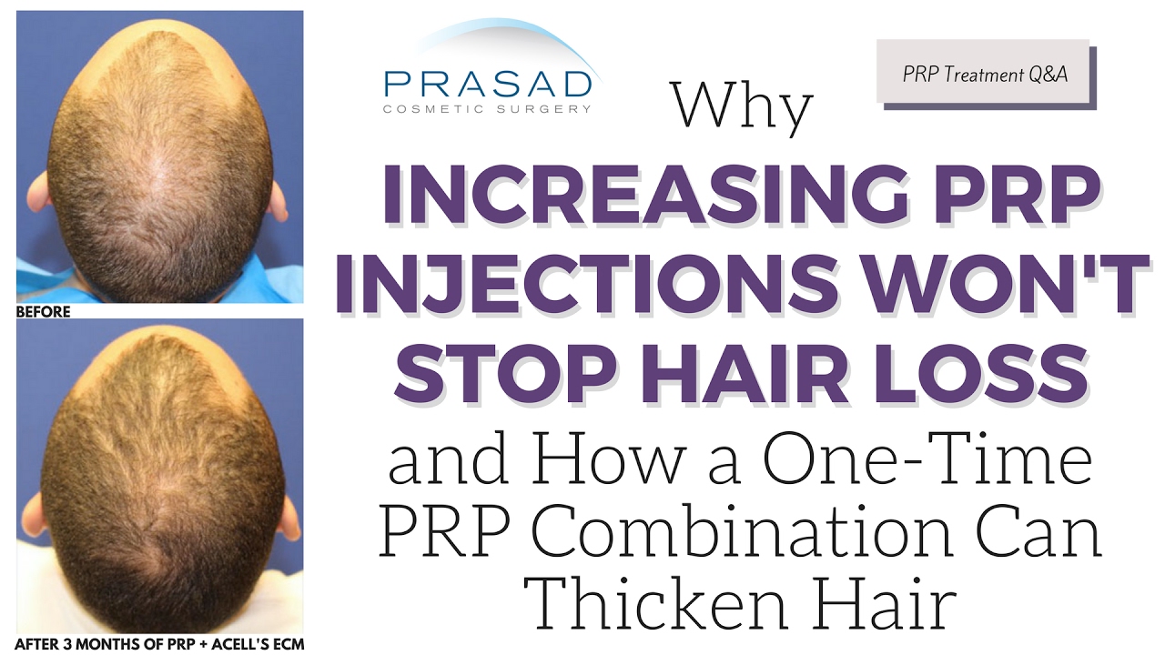 Why Increasing PRP Injections Won't Stop Hair Loss, and One-Time Treatment to Thicken Hair