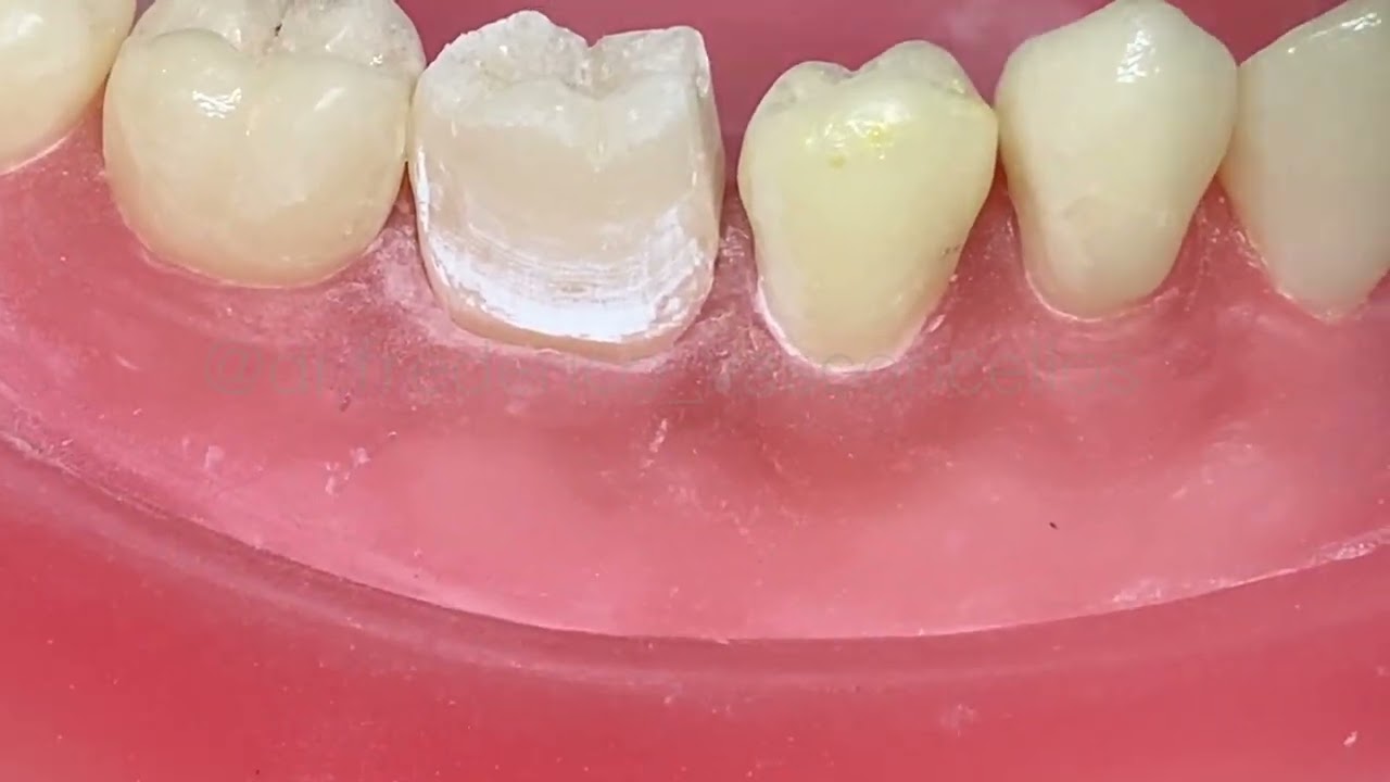 Preparo de corota total dente 46