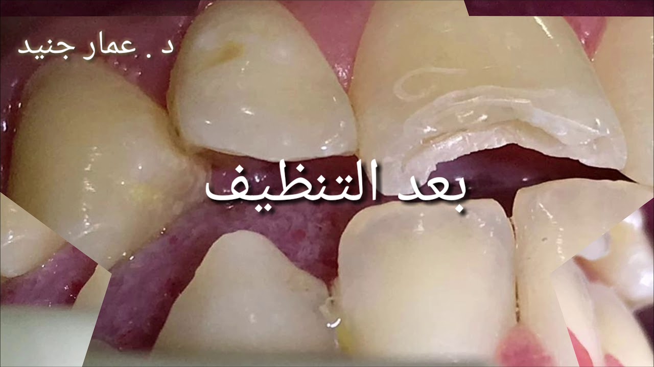 ترميم الثنية العلوية