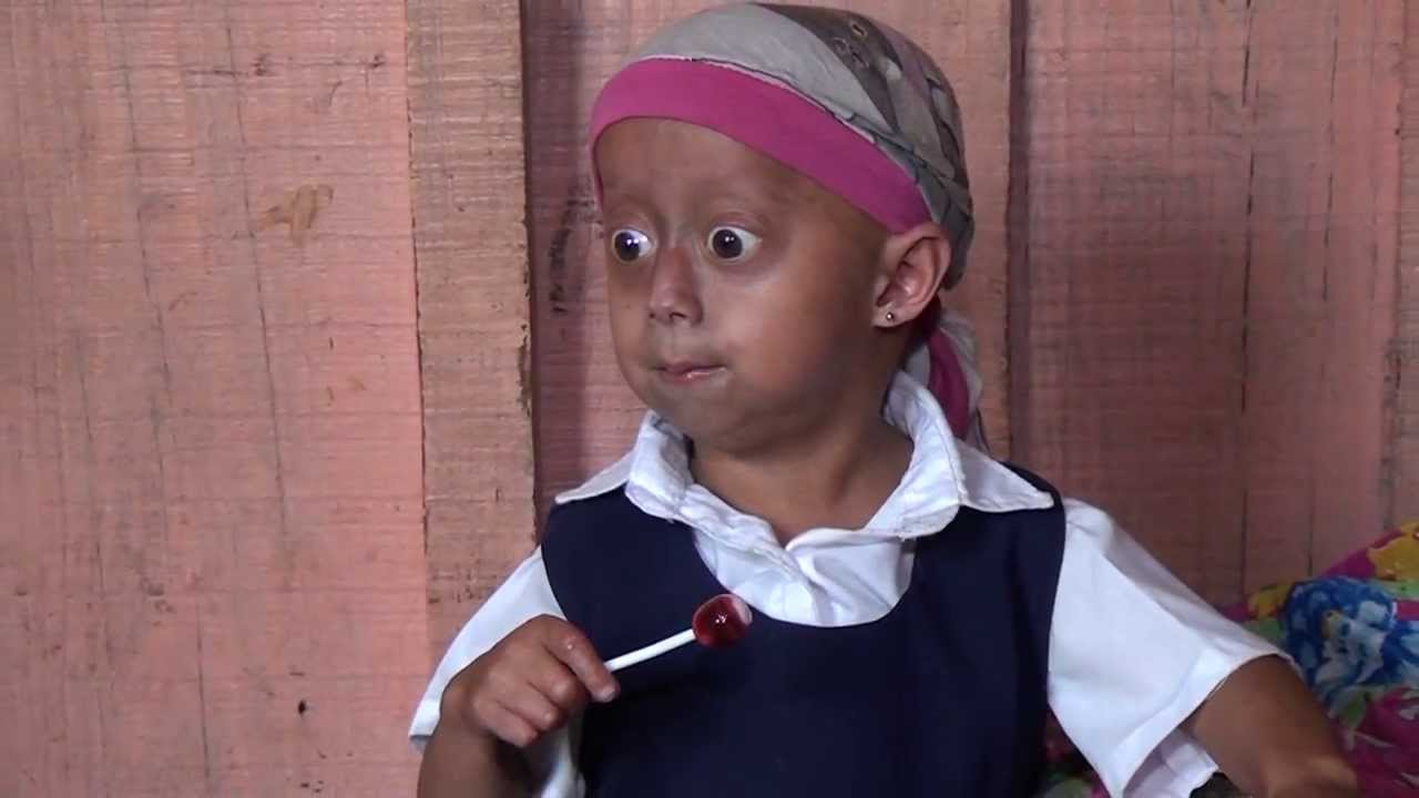 Única niña en Honduras con síndrome de Progeria.