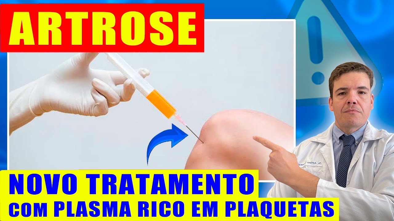 🔴 NOVO TRATAMENTO PARA ARTROSE: Plasma Rico em Plaquetas, Funciona?
