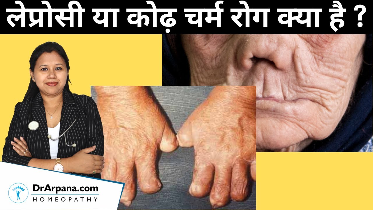 लेप्रोसी या कोढ़ चर्म रोग क्या है और इसका इलाज तथा बचाव || Leprosy Treatment