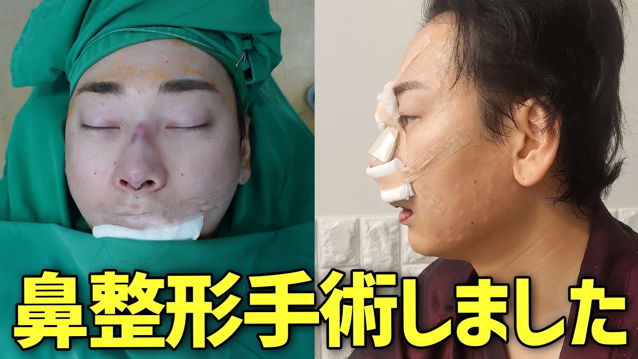 韓国で鼻の整形手術をしました！相談から完了まで全過程お見せします