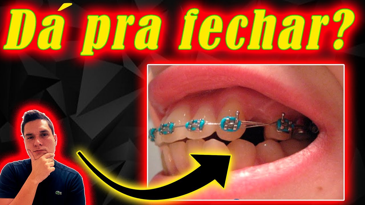 É POSSÍVEL FECHAR O ESPAÇO DE DENTE EXTRAÍDO COM APARELHO ORTODÔNTICO? | REVELEI DEFINITIVAMENTE!