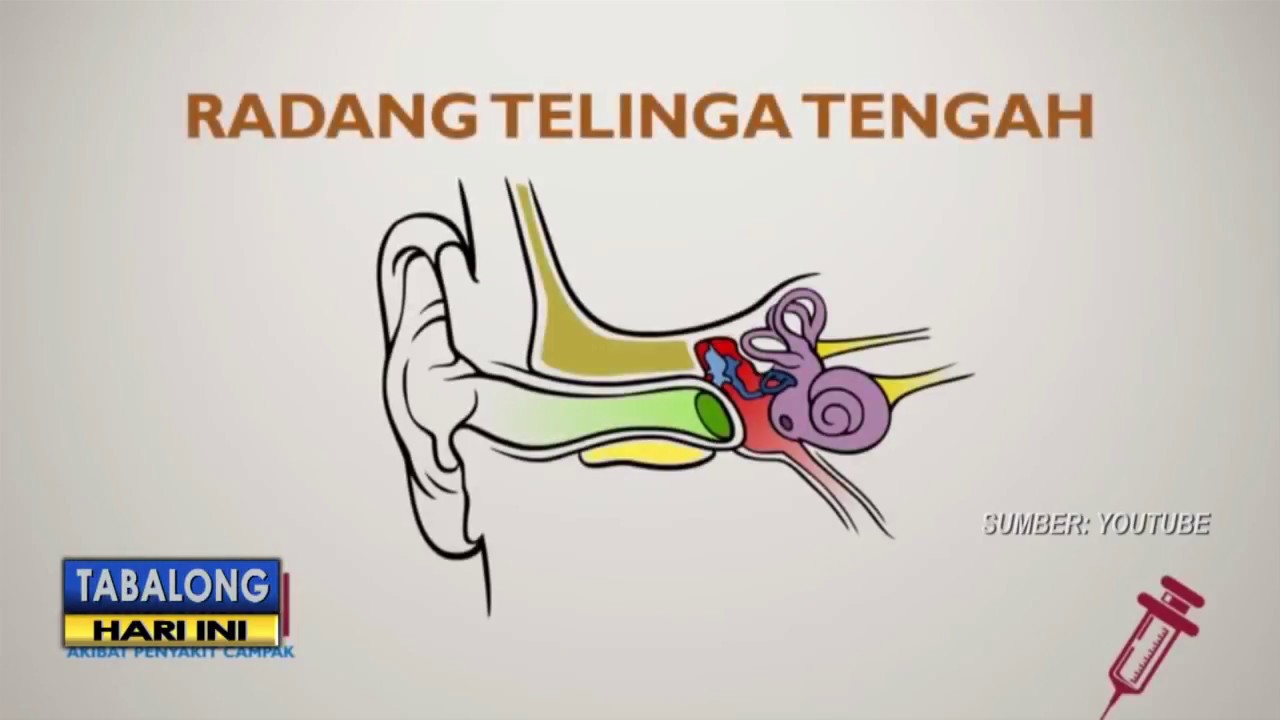 Kenali Campak dan Rubella, Di Dunia Medis Belum Ada Obat Yang Mampu Bunuh Virus Ini