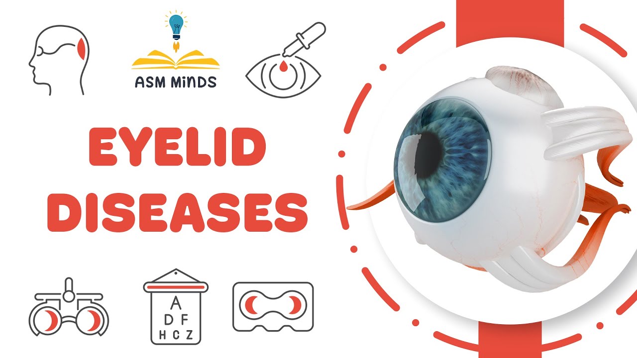 Eyelid Diseases  (Ophthalmology)