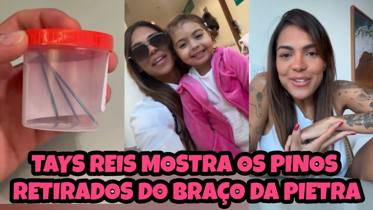 Tão inocente!! Pietra chorou querendo de volta os pinos e o gesso #taysreis #biel #pietra