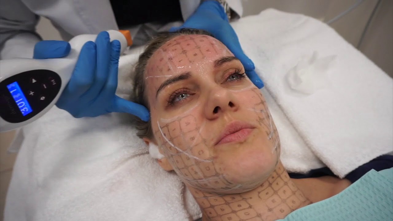 Nonsurgical skin tightening using Thermage CPT by Dr. Shaun Patel in Miami, FL