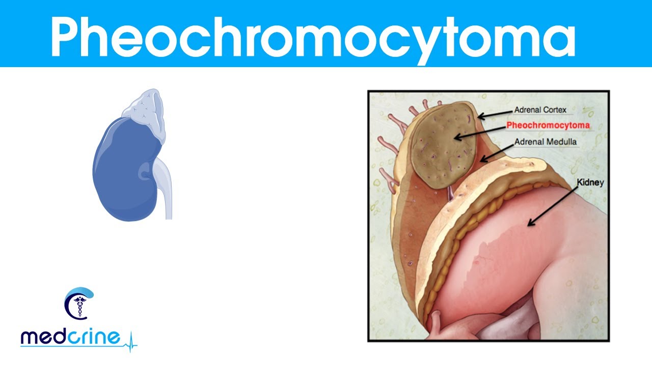 Pheochromocytoma causes,pathophysiology,symptoms and treatment