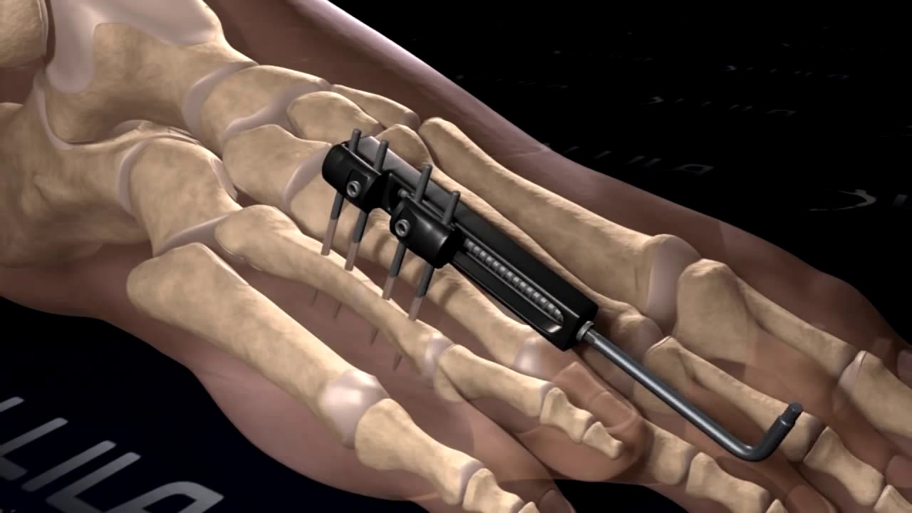 Discover the Revolutionary Brachymetatarsia Surgery Method