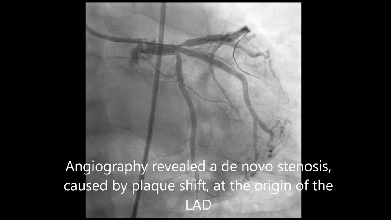 Staged Treatment of a STEMI patient with multi-vessel disease and left main involvement