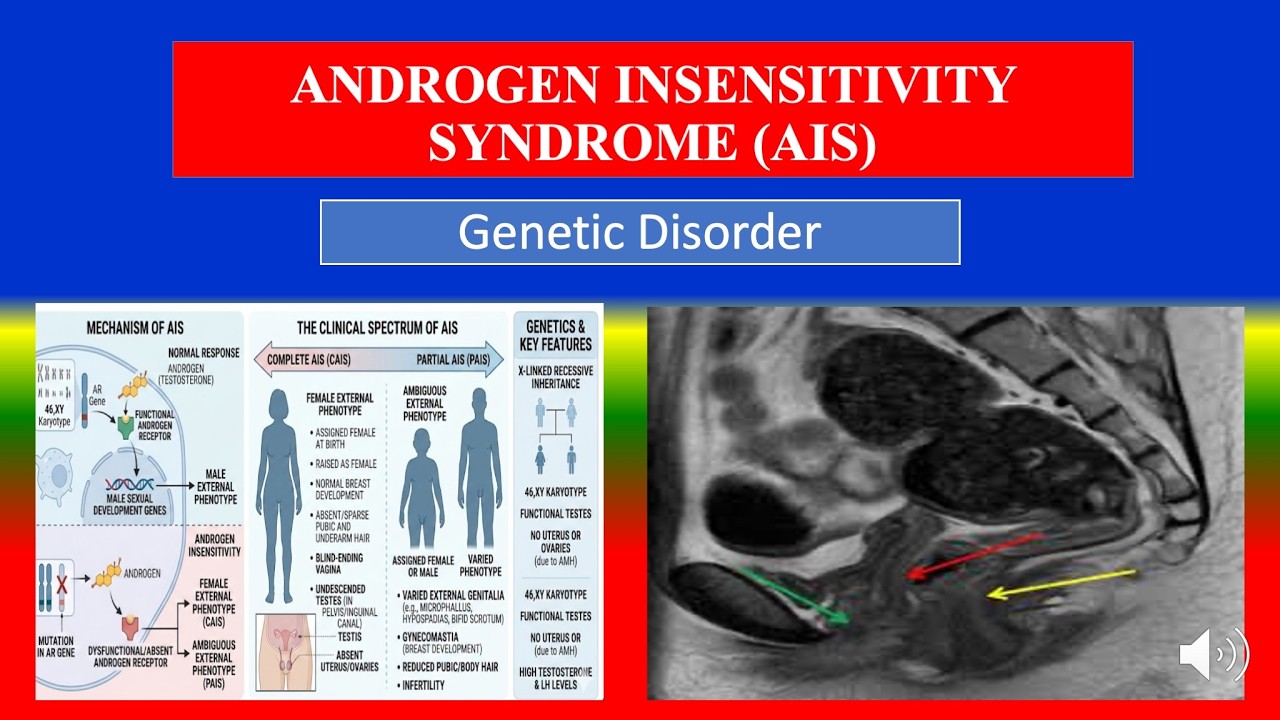 ANDROGEN INSENSITIVITY SYNDROME (AIS) -  Definition, types, causes, symptoms , diagnoses , medicine