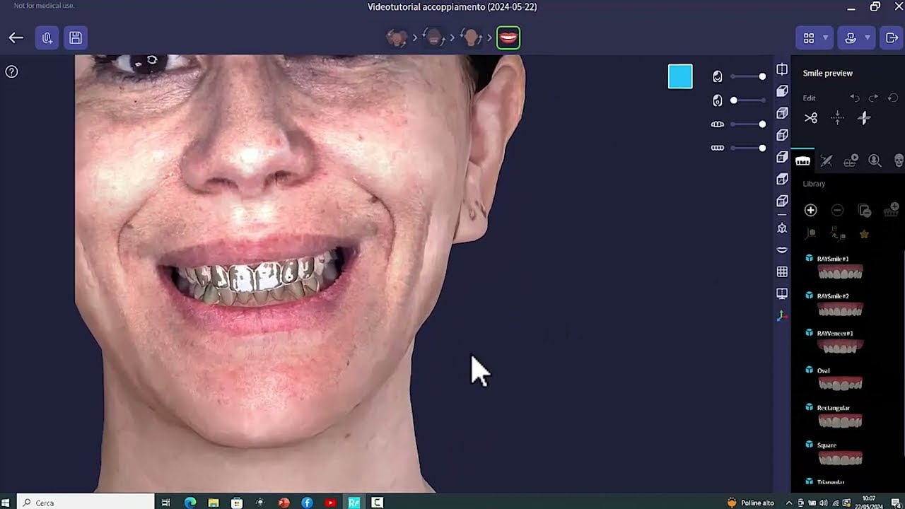 Scanner Intraorale TRIOS e Scanner Facciale RAYFACE 200: Tecniche di accoppiamento delle scansioni