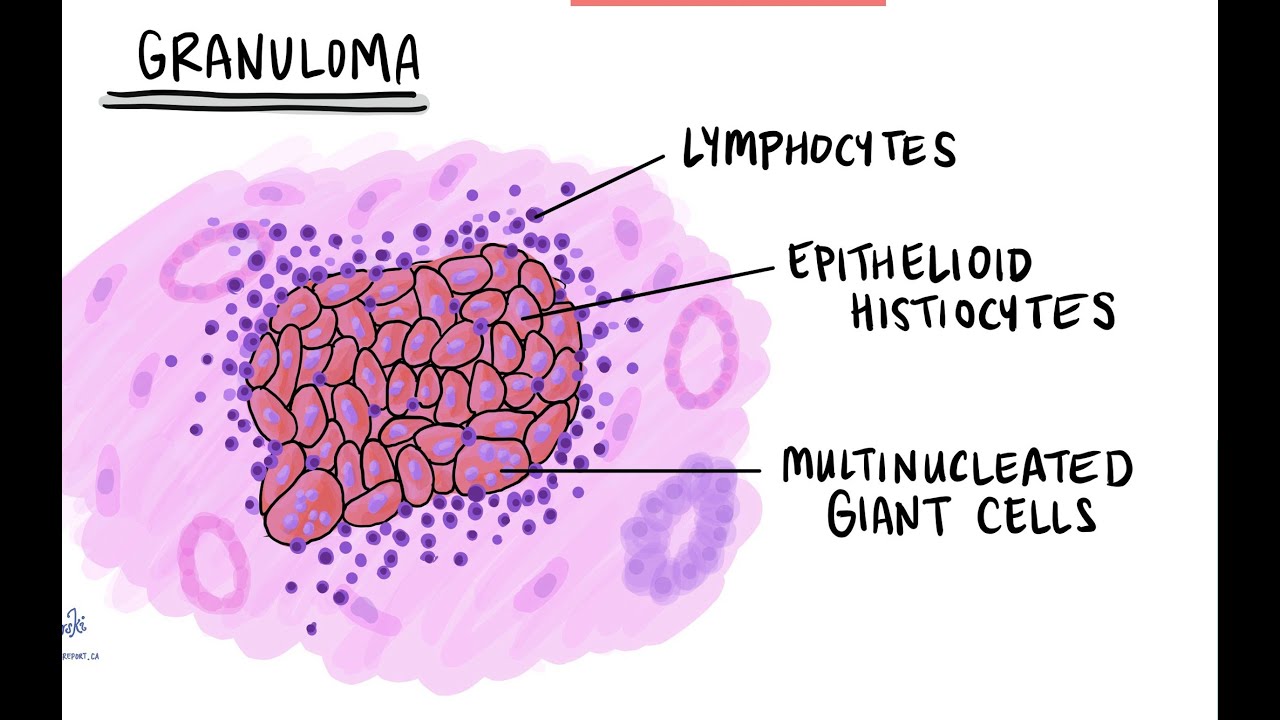 Granulomatous Tissue Reaction