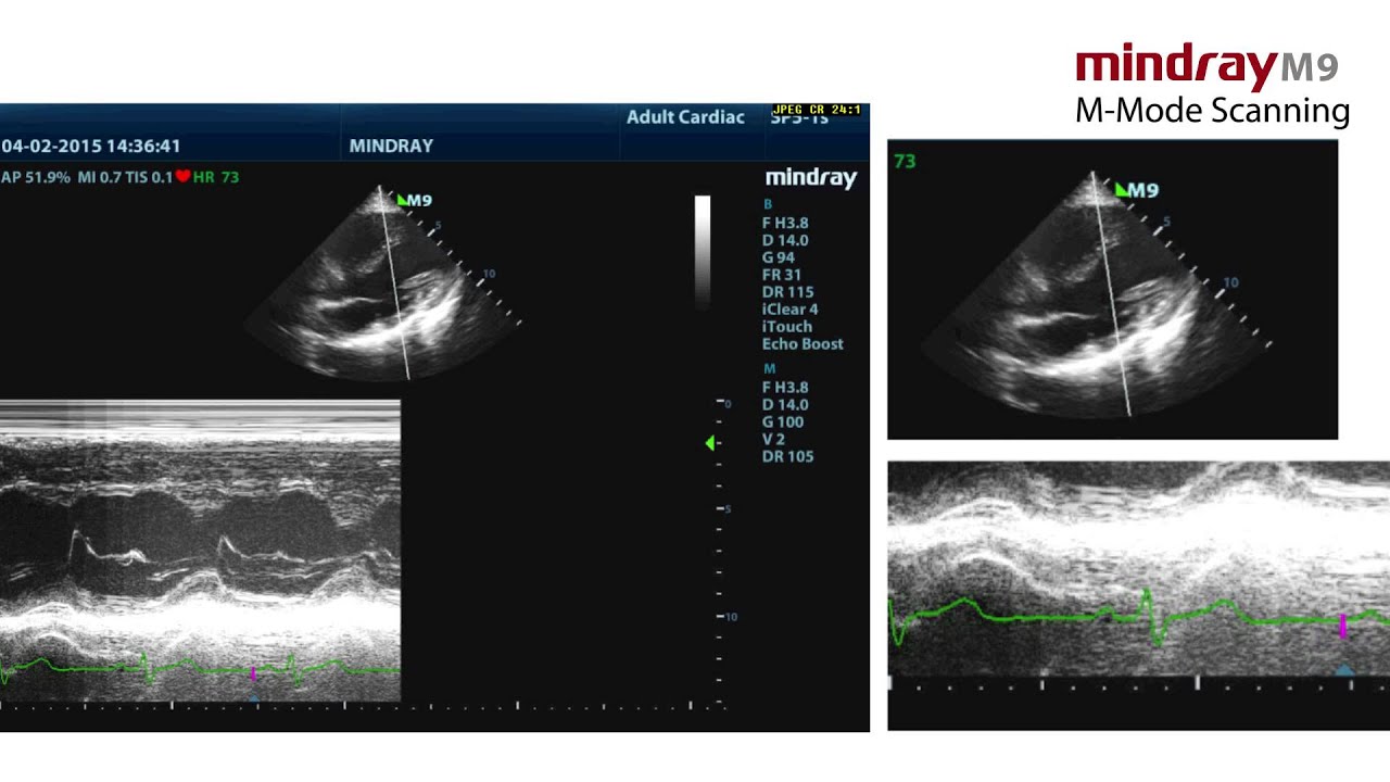 M-Mode Scanning on Mindray M9 Hand-carried Ultrasound System