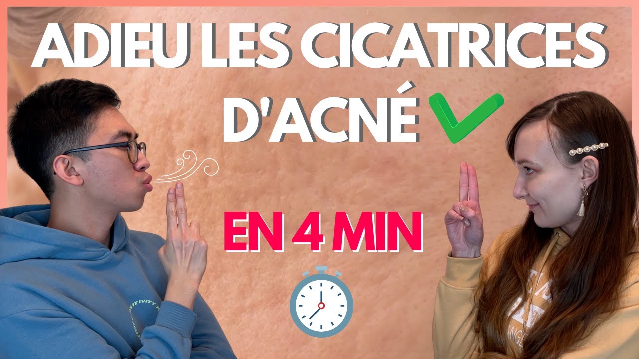 En finir avec les cicatrices d’acné (en 4 minutes) !