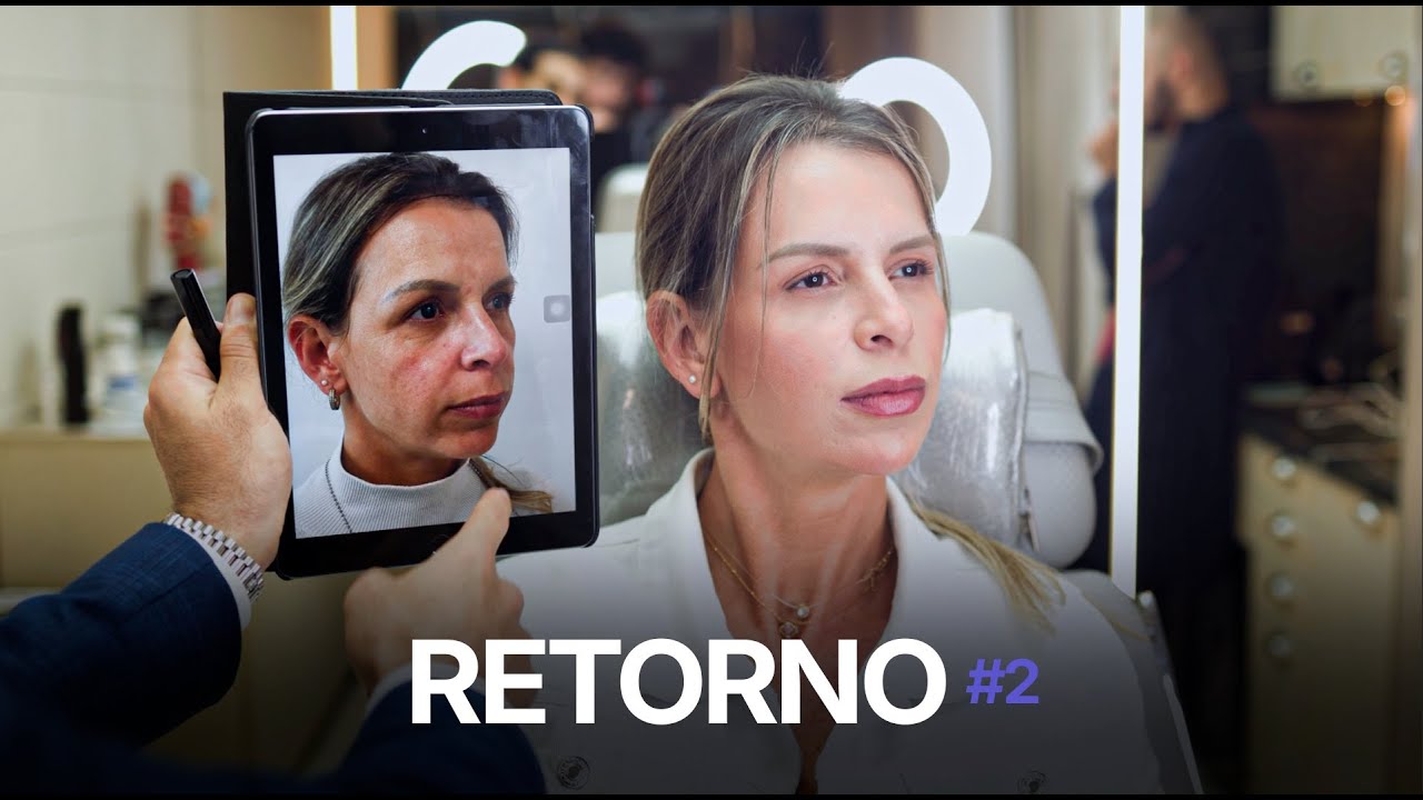 Retorno: 4 ml + Botox: Reavaliação, Ajustes Finais e Resultado Natural