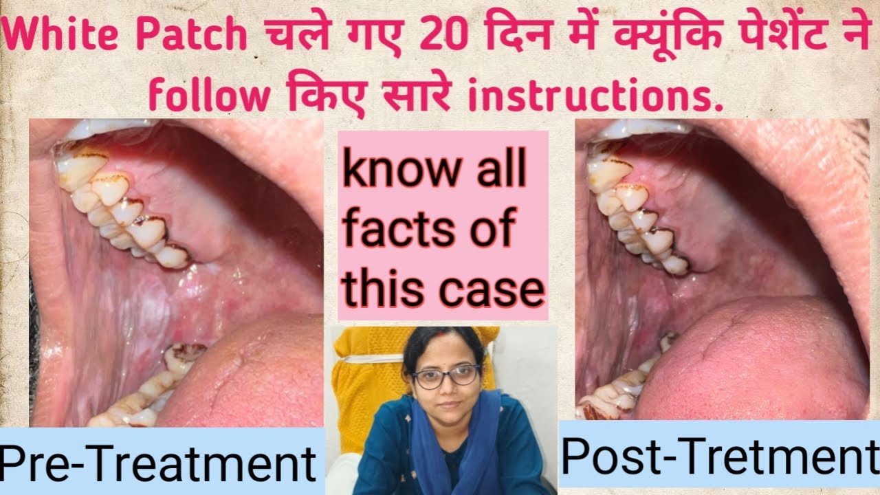 White Patch inside cheek.White Patch चले गए 20 दिन में क्यूंकि पेशेंट ने follow किए सारे instruction