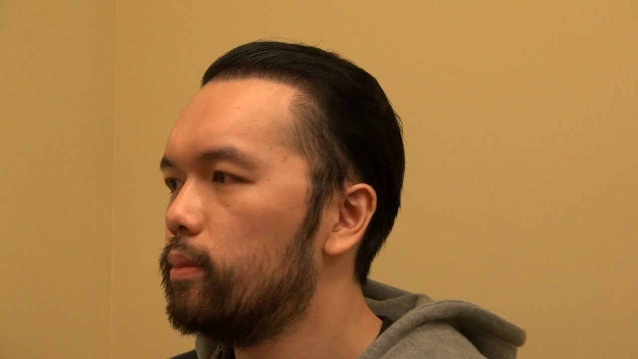 Hair transplant surgery to restore receding hairline results by Dr. Diep San Francisco, Ca