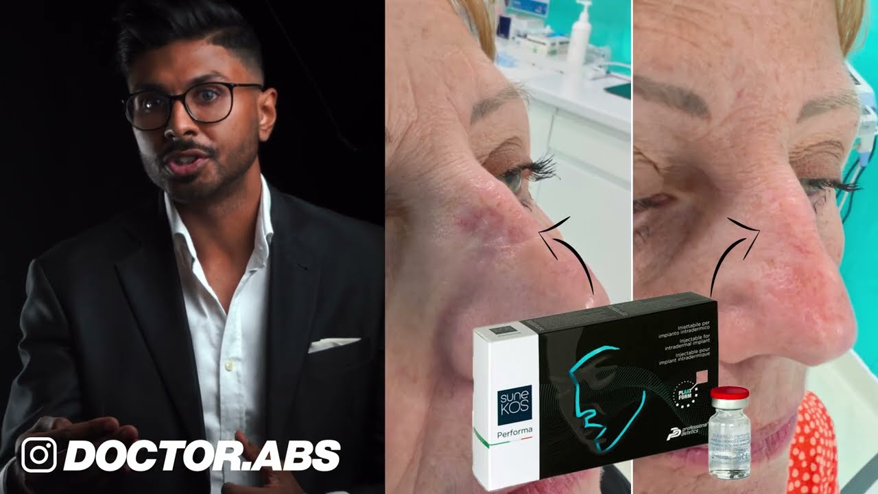 Dr Abs - Nose Scar Treatment with Sunekos Performa